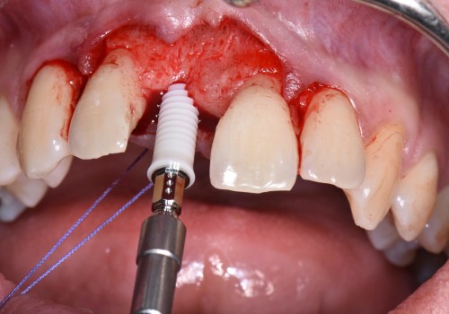 Behind The Scenes Of Dental Implants In Waco: The Crucial Role Of Dental Assistants